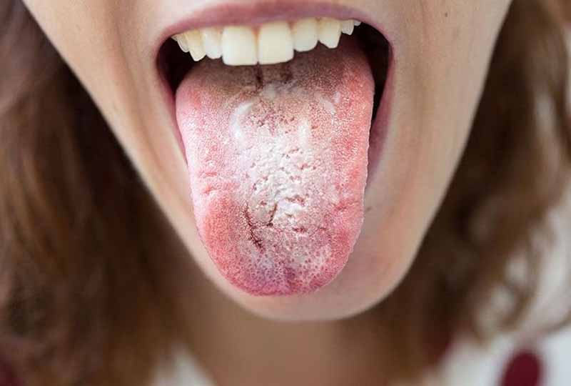 Người bệnh cần vệ sinh tưa lưỡi sạch sẽ để ngăn ngừa nấm miệng