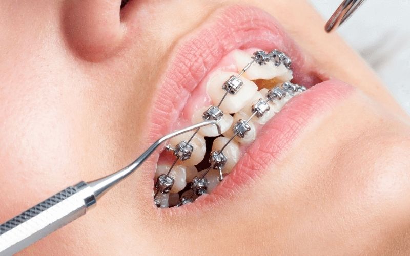 Điều trị viêm nha chu khi niềng răng khá phức tạp