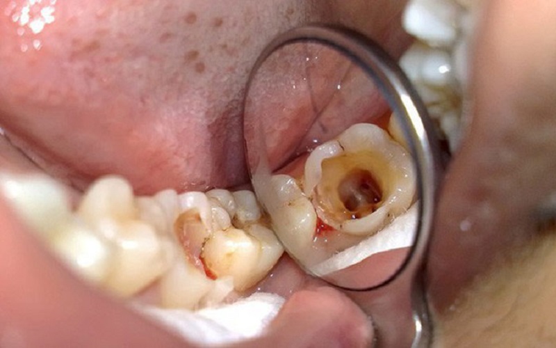 Sâu răng có thể là nguyên nhân khiến răng hàm của bạn bị đau nhức