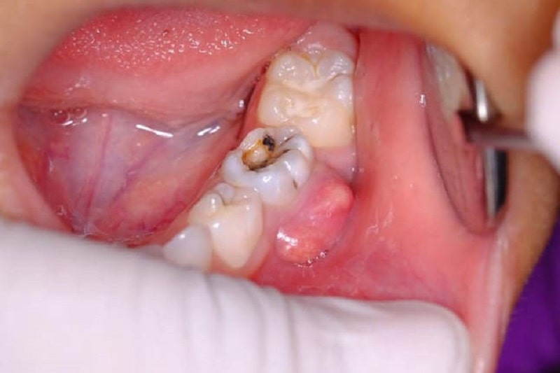 Răng hàm là vị trí dễ bị áp xe