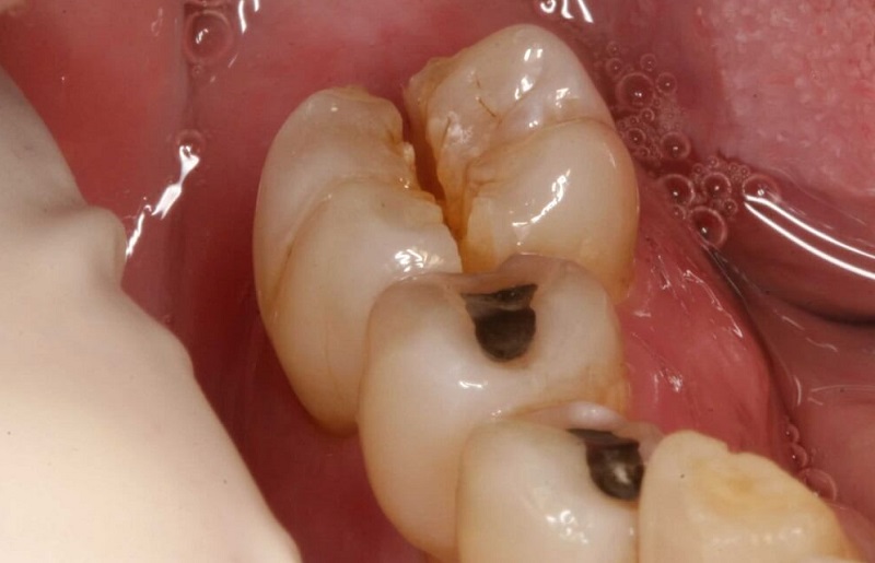 Gãy răng hay nứt răng hàm đều có thể là nguyên nhân khỏi phát triệu chứng đau nhức