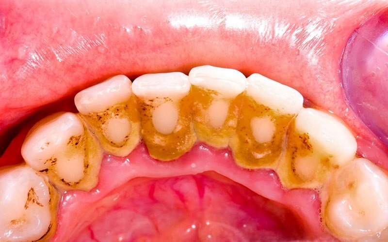Cảm giác ê buốt có thể xuất hiện do có quá nhiều mảng bám trên răng