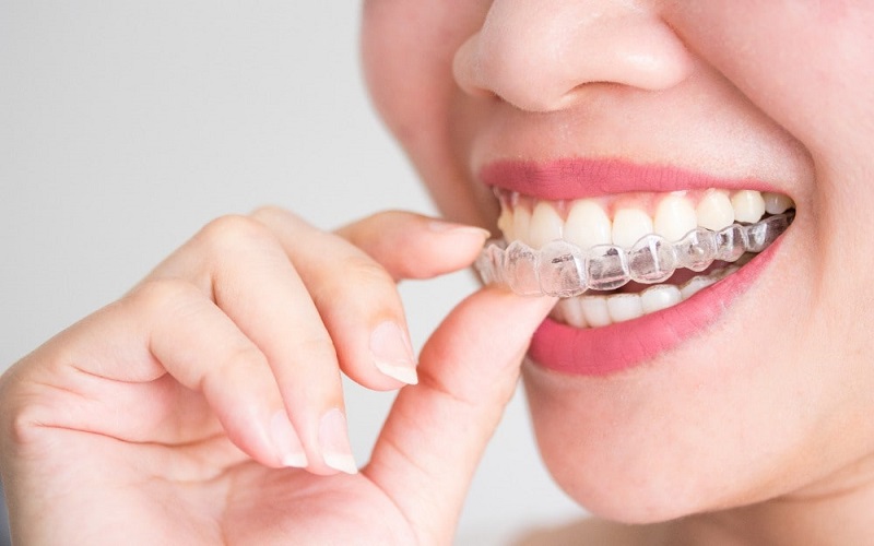 Niềng răng Ecligner được sử dụng trong nhiều trường hợp khác nhau