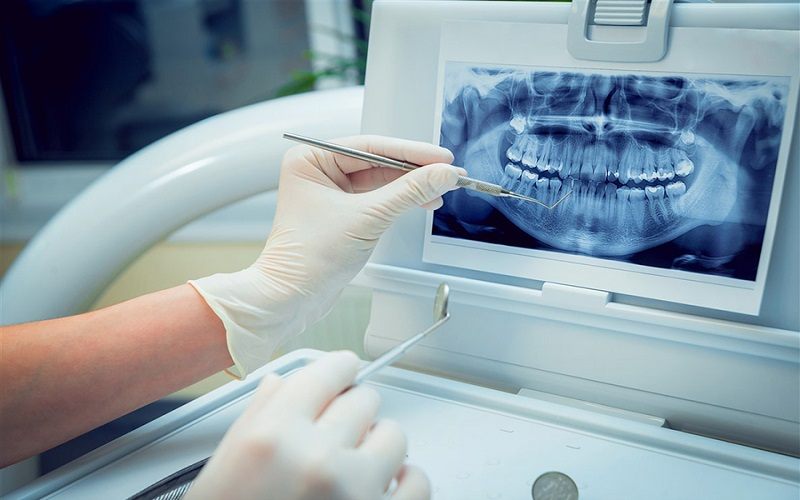 Quy trình niềng răng được thực hiện cẩn thận và kỹ lưỡng với nhiều bước