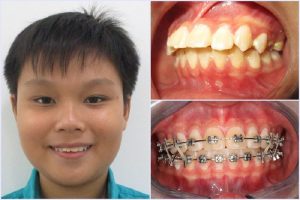Kết quả niềng răng hô hàm nhẹ