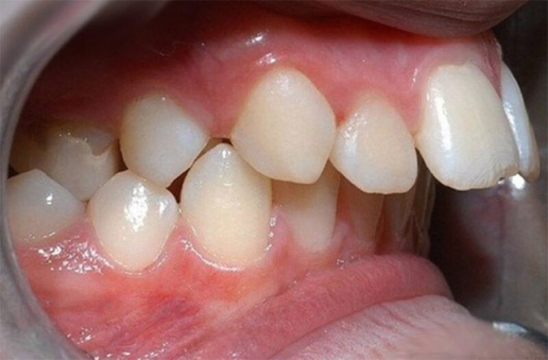 Răng hô thường gây ra nhiều ảnh hưởng đến đời sống sinh hoạt hàng ngày