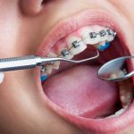 Điểm danh 3 phương pháp niềng răng khấp khểnh phổ biến hiện nay