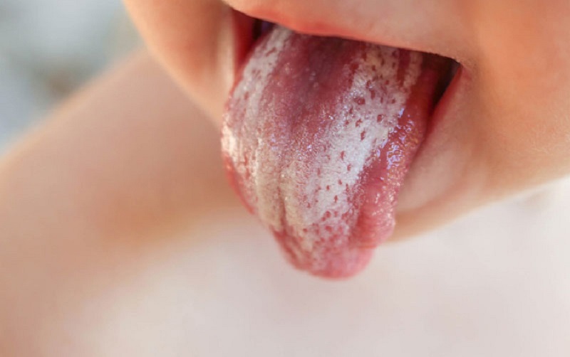 Có thể dùng thuốc để rơ lưỡi cho trẻ sơ sinh giúp điều trị nấm lưỡi