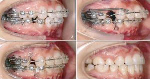 Các bước trong quá trình niềng răng là vẫn đề được nhiều người quan tâm