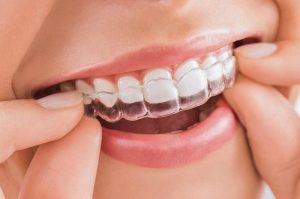 Các loại niềng răng trong suốt hiệu quả cao