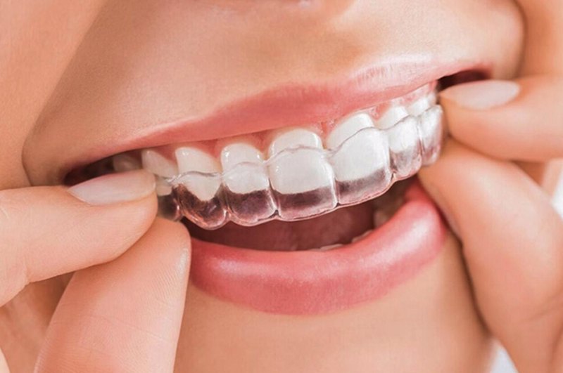 Niềng răng 1 hàm bằng khay trong suốt có chi phí cao hơn các loại niềng khác