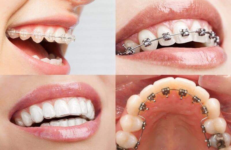Chi phí niềng răng hai hàm phụ thuộc phần lớn vào chất liệu niềng 