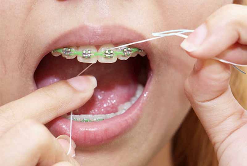 Cần chăm sóc răng miệng đúng cách trong giai đoạn chỉnh nha