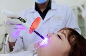 Trám răng bằng công nghệ Laser Tech tại ViDental