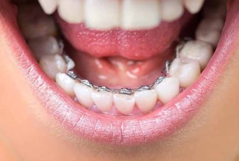Việc niềng răng không đúng cách là nguyên nhân gây tụt lợi