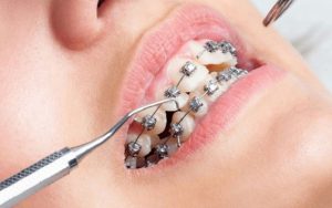 Niềng răng bị tụt lợi: Nguyên nhân và giải pháp khắc phục