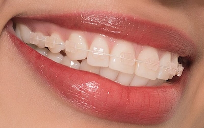 Niềng răng mắc cài sứ là phương pháp chỉnh nha được ưa chuộng hiện nay