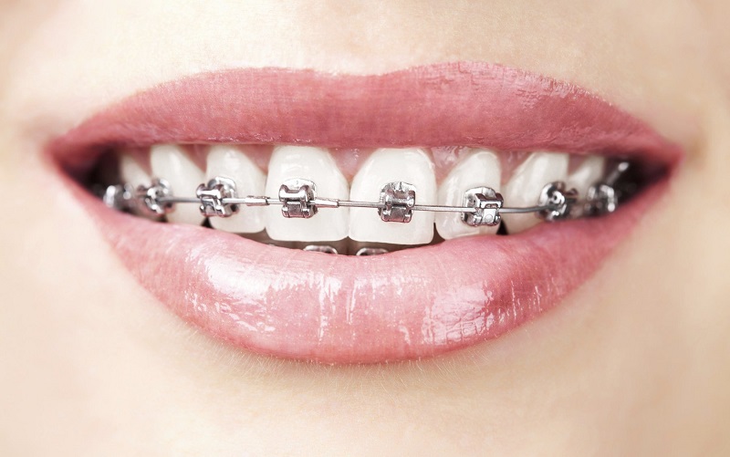 Niềng răng móm mất bao nhiêu tiền khi sử dụng mắc cài kim loại