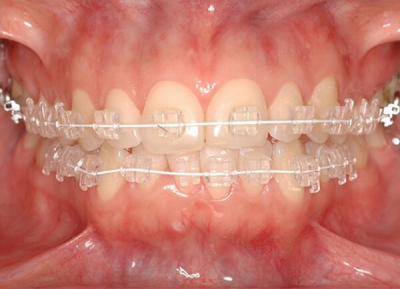 Niềng răng mắc cài pha lê có nhiều ưu điểm hơn so với mắc cài sứ