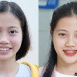 Niềng răng thay đổi khuôn mặt ngày càng cân đối hơn