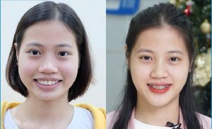 Niềng răng thay đổi khuôn mặt ngày càng cân đối hơn