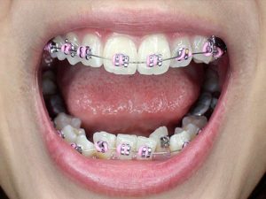 Tại sao niềng răng xong vẫn xấu? Cách khắc phục hiệu quả nhất