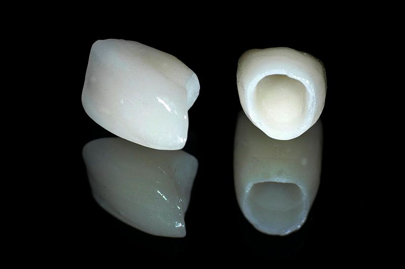Răng sứ Cercon cho hiệu quả chỉnh nha tốt và an toàn khi thực hiện