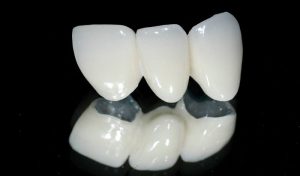 Bọc răng sứ Cercon là kỹ thuật gì, có tốt không, giá bao nhiêu?