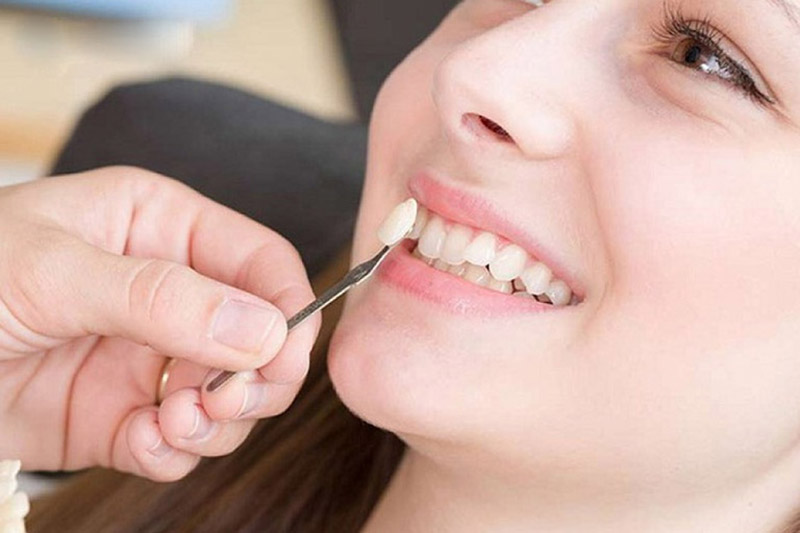 Bọc răng khểnh đem lại hiệu quả thẩm mỹ cao