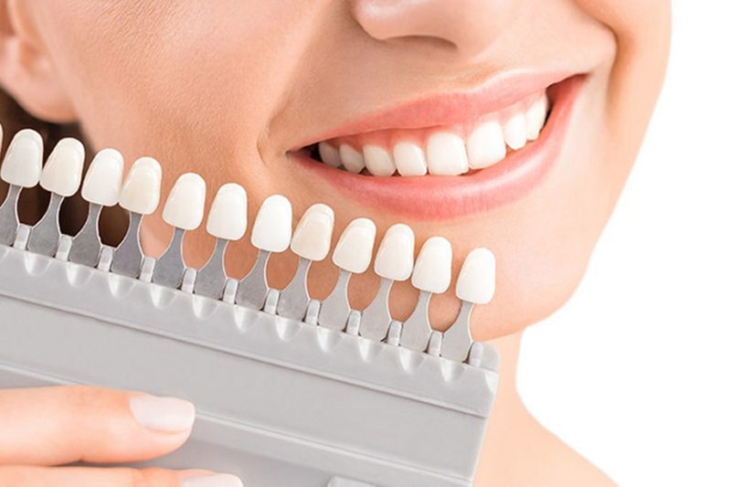 Quy trình bọc răng sứ cho răng khểnh diễn ra theo 4 bước