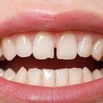 Bọc răng sứ cho răng thưa là gì? Quy trình, bảng giá CHI TIẾT