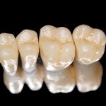 Bọc răng sứ Titan: Ưu nhược điểm và quy trình thực hiện