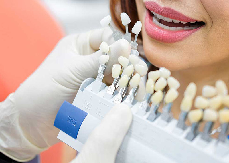 Giá bọc răng sứ venus phụ thuộc vào nhiều yếu tố