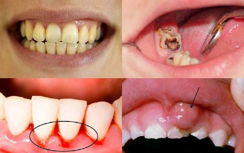 Một số tác hại nguy hiểm khi vôi răng tích tụ lâu ngày