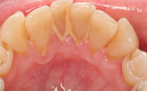 Cao răng là gì? Cách loại bỏ và phòng tránh hiệu quả nhất