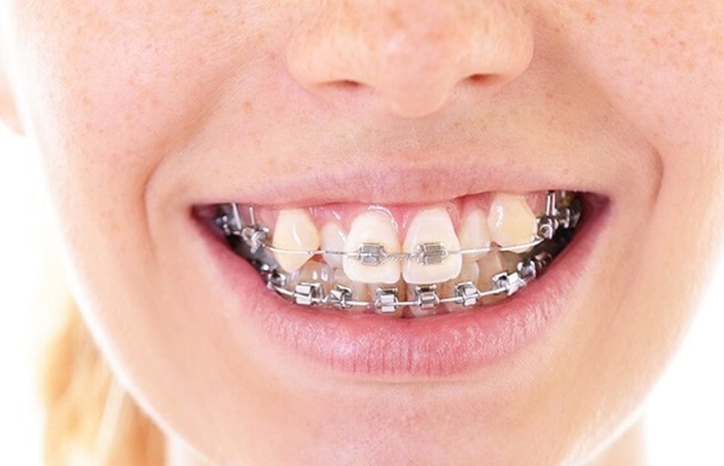 Niềng răng khểnh là phương pháp ít gây xâm lấn