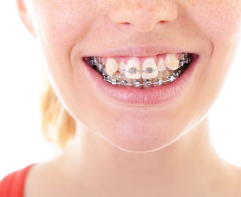 Niềng răng khấp khểnh có đem lại hiệu quả hay không?