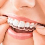 Niềng răng hô bằng nhựa có thực sự hiệu quả như bạn nghĩ? Ưu và nhược điểm?