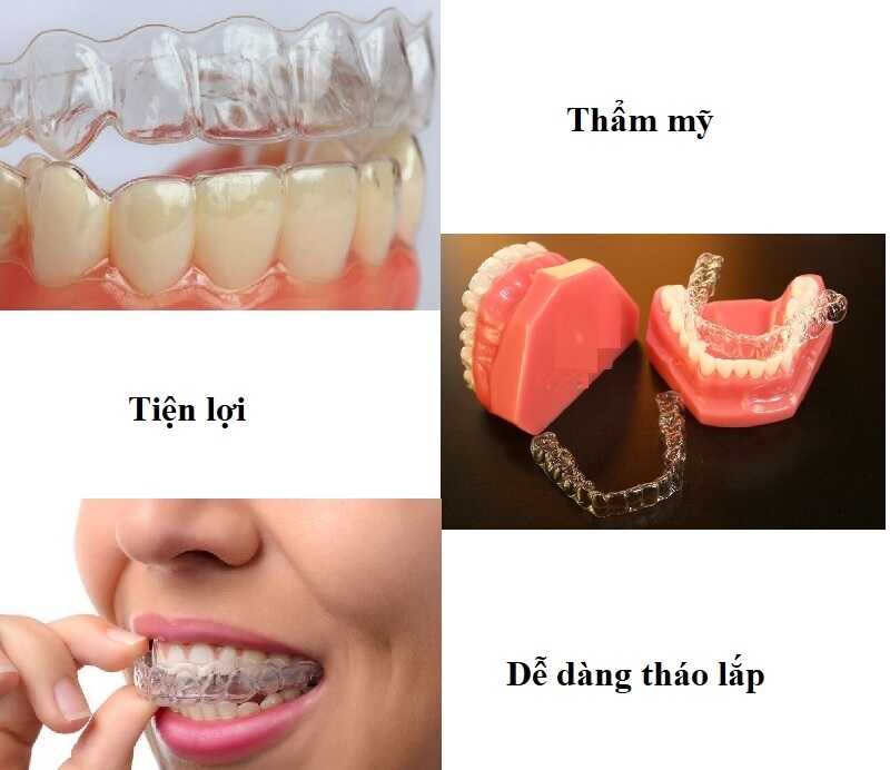 Kỹ thuật niềng răng nhựa nhiều ưu điểm
