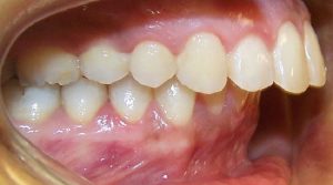 Niềng răng hô không nhổ răng đúng hay không? Địa chỉ khắc phục uy tín