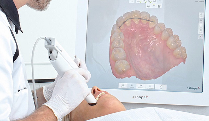 Lấy dấu răng bằng công nghệ 3D