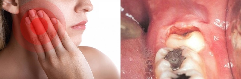 Một số biến chứng ảnh hưởng đến sức khỏe của răng số 8