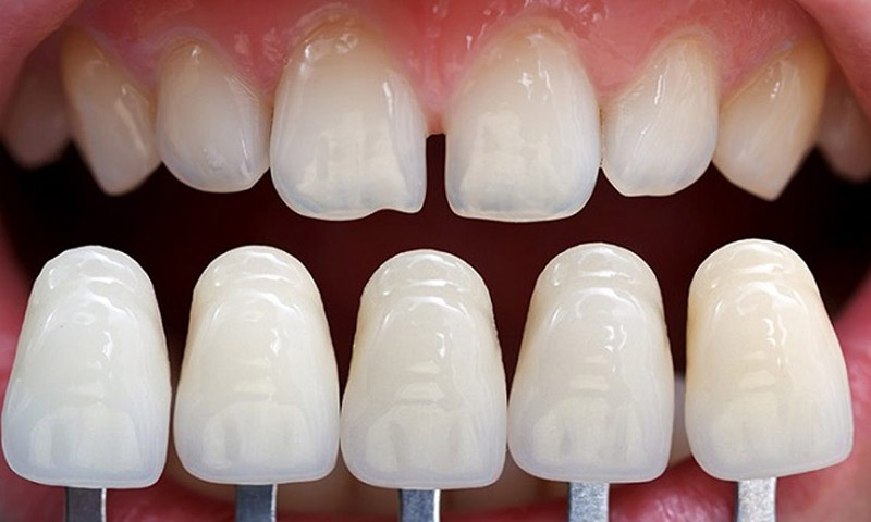 Do có nhiều ưu điểm, răng toàn sứ luôn được ưu tiên lựa chọn