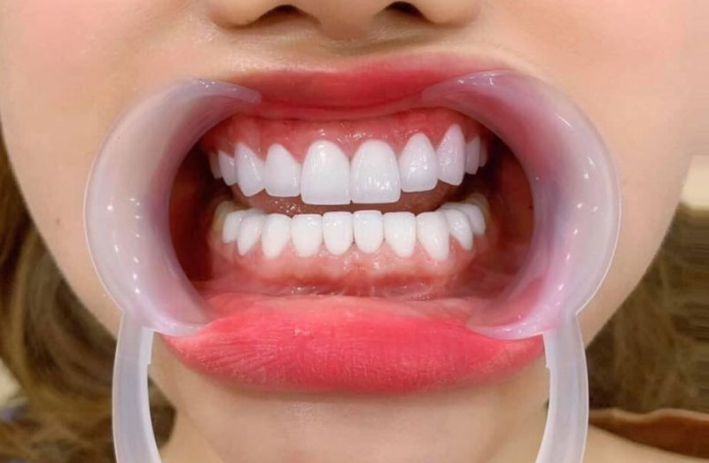 Bọc sứ răng cửa được thực hiện với các bước rất cơ bản