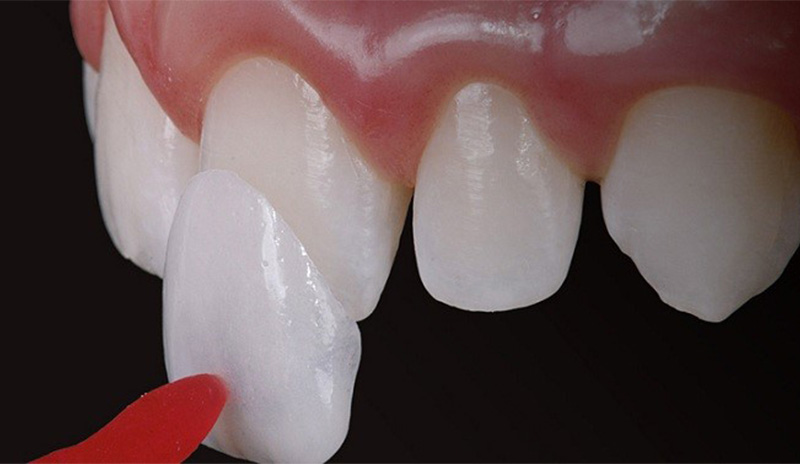 Bảng giá của bọc răng sứ cho răng cửa khác biệt qua từng chất liệu mão