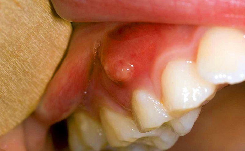 Hiện tượng nang răng gây sưng tấy vùng chân răng