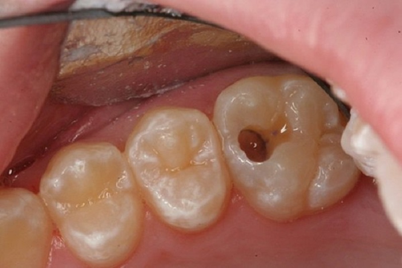 Nang răng ở giai đoạn đầu nhỏ, ảnh hưởng ít đến răng 