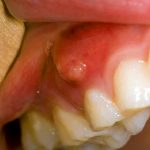 Nang răng và những điều cần biết về nang răng