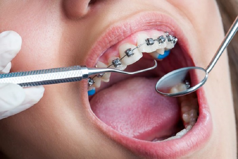 Chi phí niềng răng hô phụ thuộc vào cơ sở nha khoa làm răng