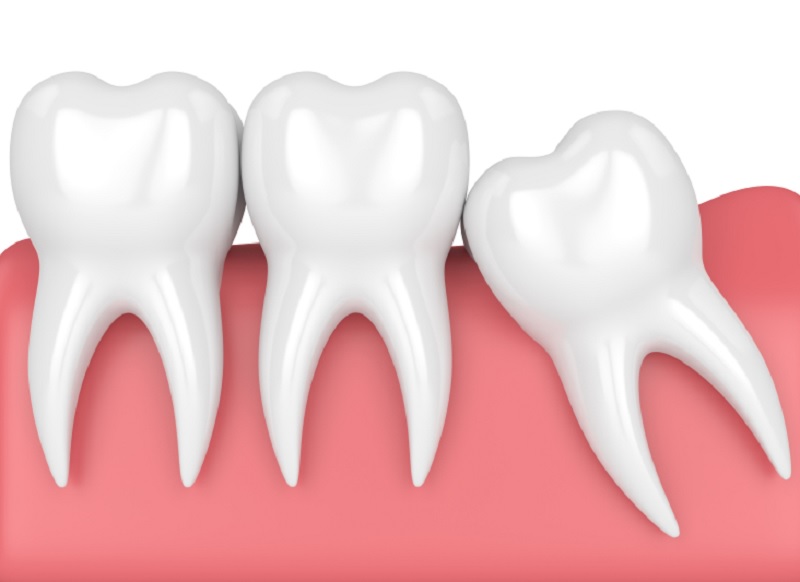 Liệu niềng răng có phải nhổ răng khôn không?